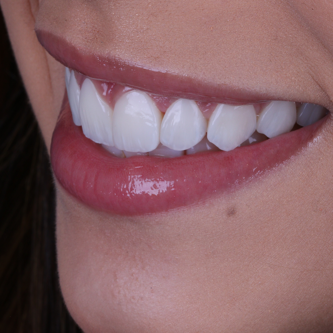 Transformação de sorriso realizada pela Dra. Fernanda Barros